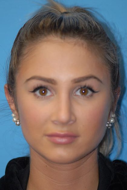 Otoplasty Before & After Patient #1961