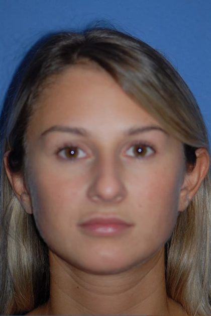 Otoplasty Before & After Patient #1961