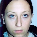 Otoplasty Before & After Patient #1959