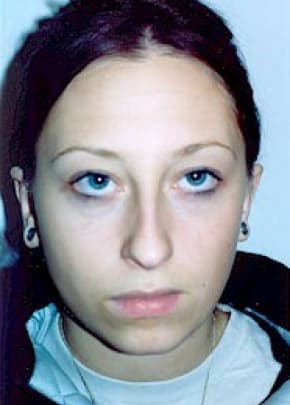 Otoplasty Before & After Patient #1959