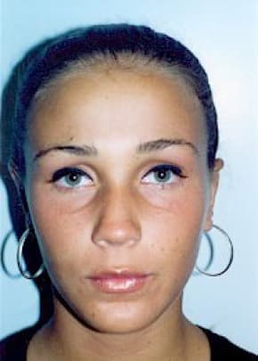 Otoplasty Before & After Patient #1957
