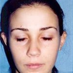 Otoplasty Before & After Patient #1957