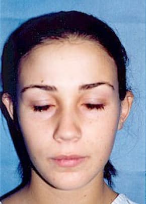 Otoplasty Before & After Patient #1957