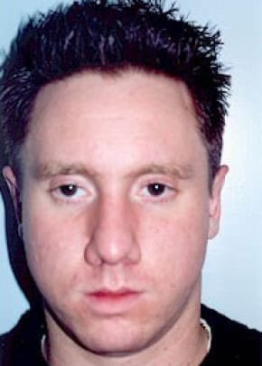 Otoplasty Before & After Patient #1956
