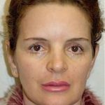 Otoplasty Before & After Patient #1955