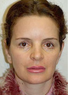 Otoplasty Before & After Patient #1955