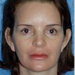 Otoplasty Before & After Patient #1955