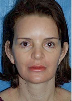 Otoplasty Before & After Patient #1955
