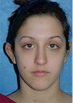 Otoplasty Before & After Patient #1954