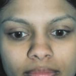 Otoplasty Before & After Patient #1953