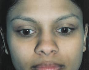 Otoplasty Before & After Patient #1953