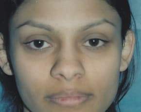 Otoplasty Before & After Patient #1953
