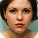 Otoplasty Before & After Patient #1952