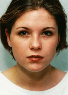 Otoplasty Before & After Patient #1952