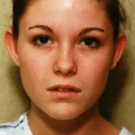 Otoplasty Before & After Patient #1952