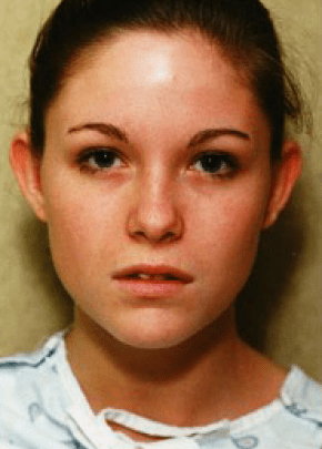 Otoplasty Before & After Patient #1952
