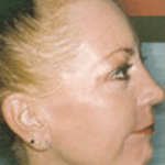 Skin Peels Before & After Patient #2248
