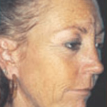 Skin Peels Before & After Patient #2248