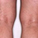 Spider Vein Removal Before & After Patient #2261