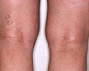 Spider Vein Removal Before & After Patient #2261