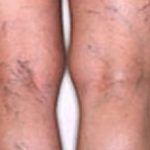 Spider Vein Removal Before & After Patient #2261