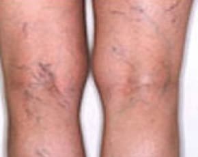 Spider Vein Removal Before & After Patient #2261