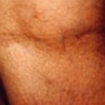 Spider Vein Removal Before & After Patient #2260