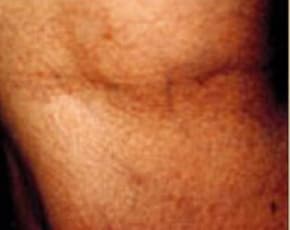 Spider Vein Removal Before & After Patient #2260