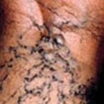 Spider Vein Removal Before & After Patient #2260