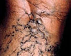 Spider Vein Removal Before & After Patient #2260