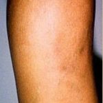 Spider Vein Removal Before & After Patient #2259