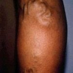 Spider Vein Removal Before & After Patient #2259
