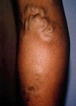 Spider Vein Removal Before & After Patient #2259