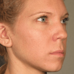 Ultherapy Before & After Patient #2194