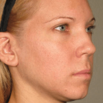 Ultherapy Before & After Patient #2194