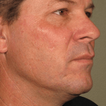 Ultherapy Before & After Patient #2193