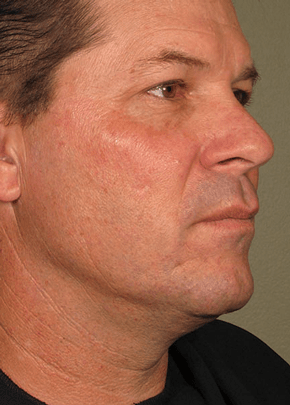 Ultherapy Before & After Patient #2193