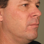 Ultherapy Before & After Patient #2193