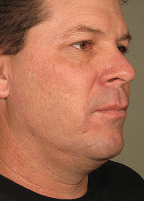 Ultherapy Before & After Patient #2193