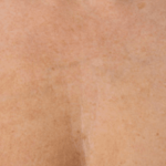 Ultherapy Before & After Patient #2192
