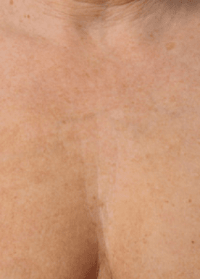 Ultherapy Before & After Patient #2192