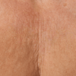 Ultherapy Before & After Patient #2192