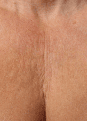 Ultherapy Before & After Patient #2192