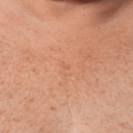 Ultherapy Before & After Patient #2191