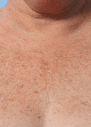 Ultherapy Before & After Patient #2191