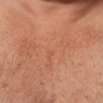 Ultherapy Before & After Patient #2191