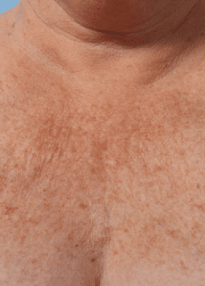 Ultherapy Before & After Patient #2191