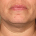 Ultherapy Before & After Patient #2190