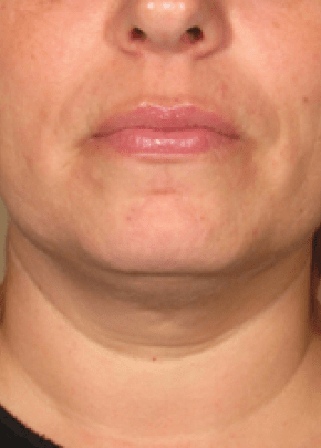 Ultherapy Before & After Patient #2190