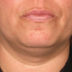 Ultherapy Before & After Patient #2190